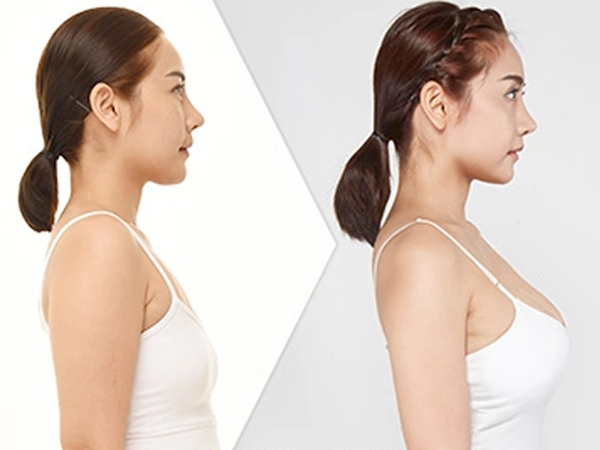Oplas Payudara - Ilustrasi-Net